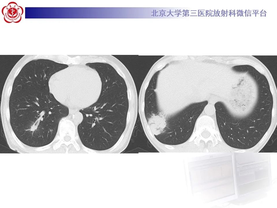影像PPT - 【PPT】肺隐球菌病的影像-6