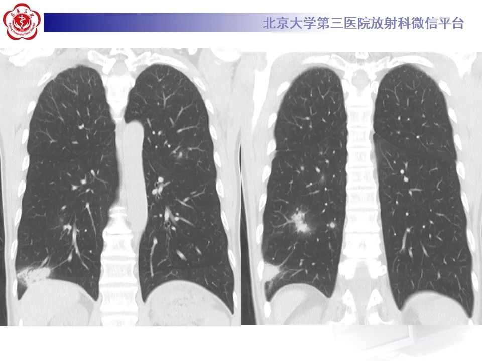 影像PPT - 【PPT】肺隐球菌病的影像-7