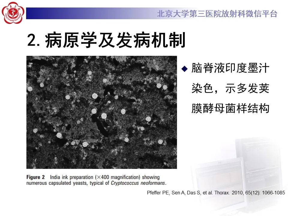 影像PPT - 【PPT】肺隐球菌病的影像-15