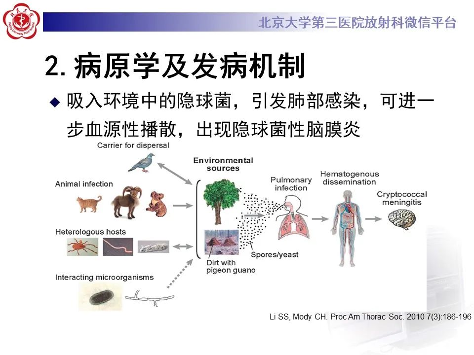 影像PPT - 【PPT】肺隐球菌病的影像-16