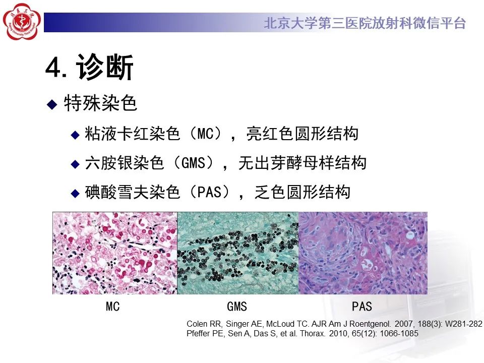 影像PPT - 【PPT】肺隐球菌病的影像-20