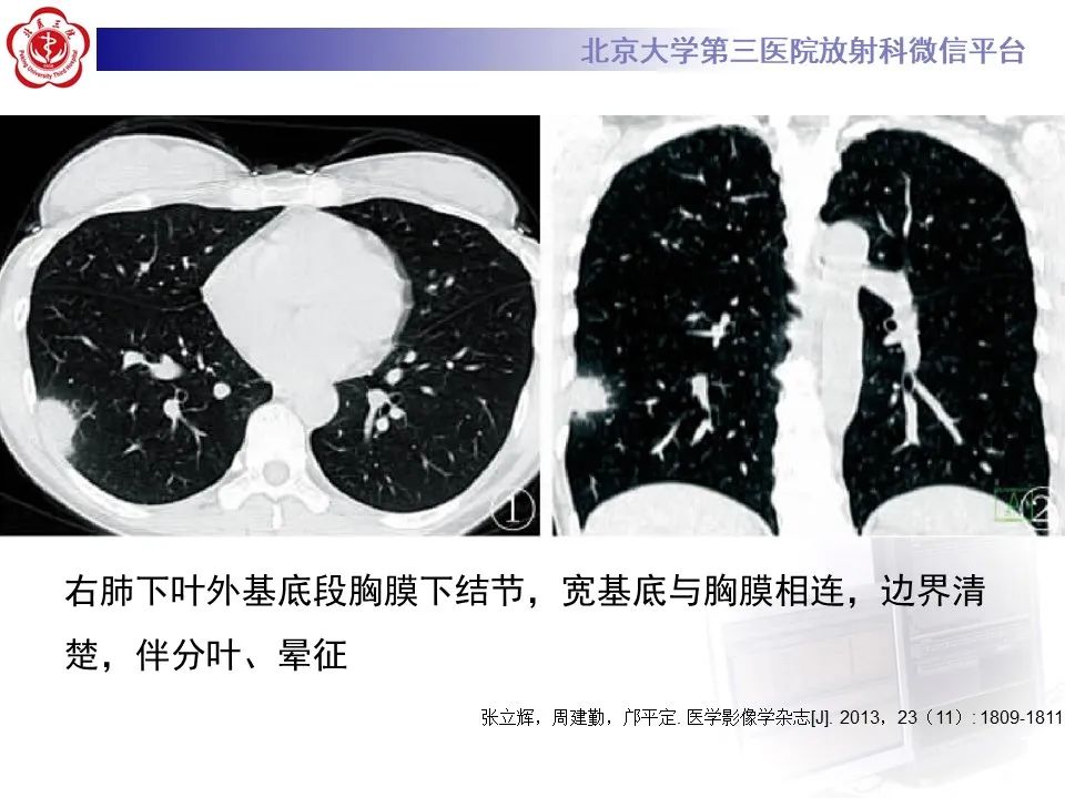 影像PPT - 【PPT】肺隐球菌病的影像-23