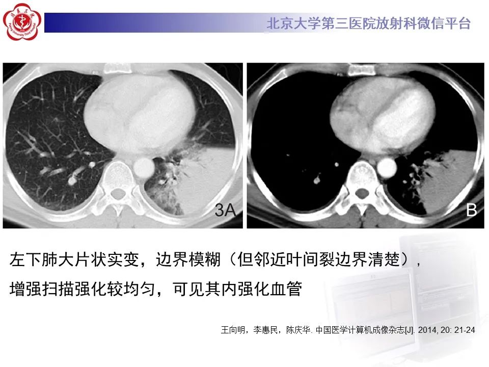 影像PPT - 【PPT】肺隐球菌病的影像-25