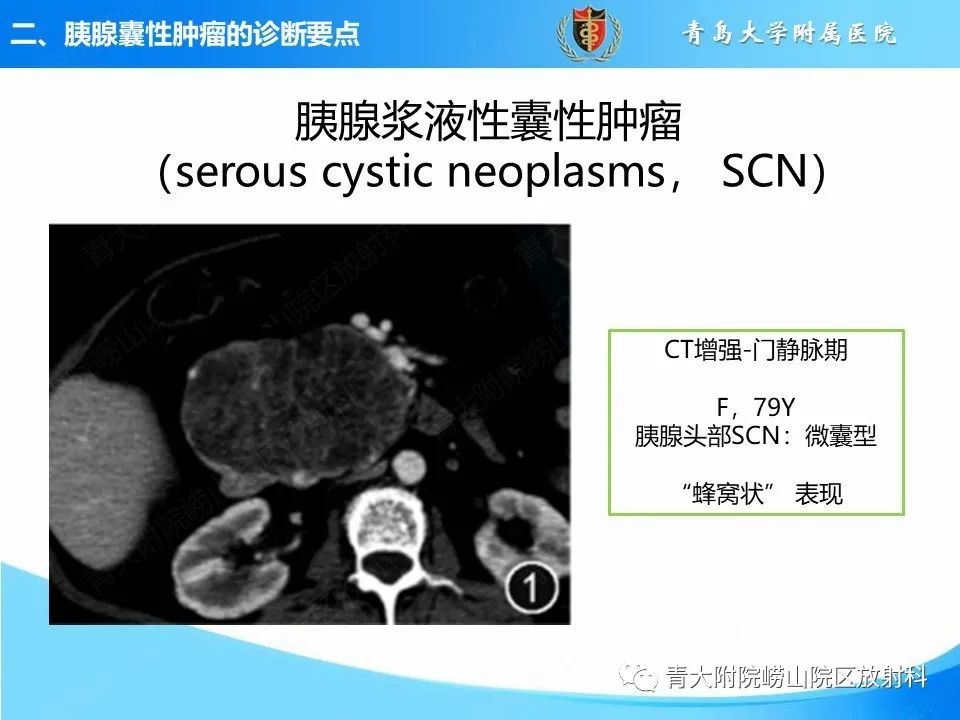 影像PPT - 【PPT】胰腺囊性肿瘤的影像诊断思路-9