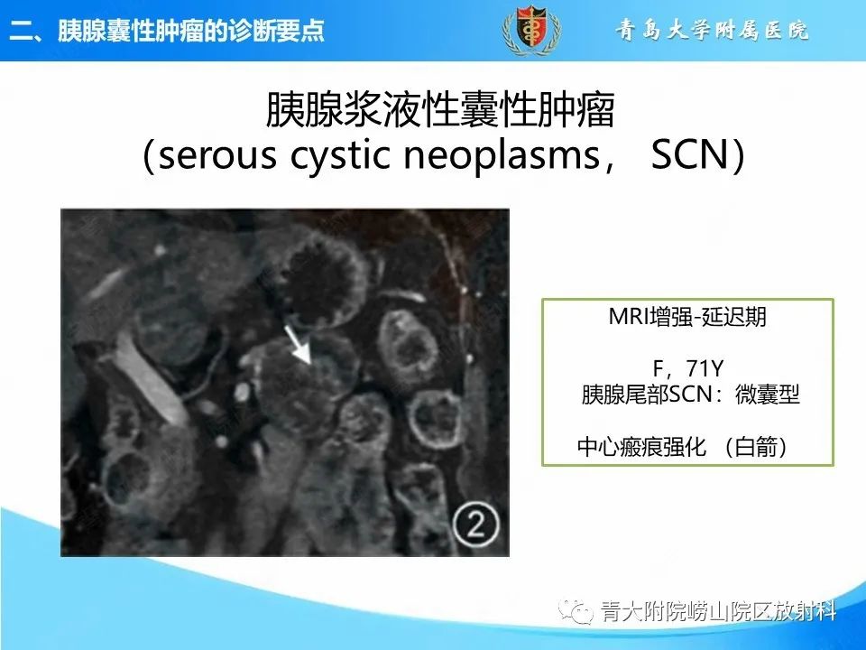 影像PPT - 【PPT】胰腺囊性肿瘤的影像诊断思路-10