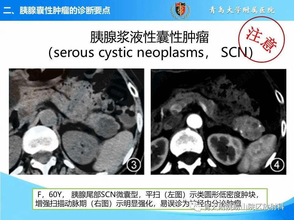 影像PPT - 【PPT】胰腺囊性肿瘤的影像诊断思路-11