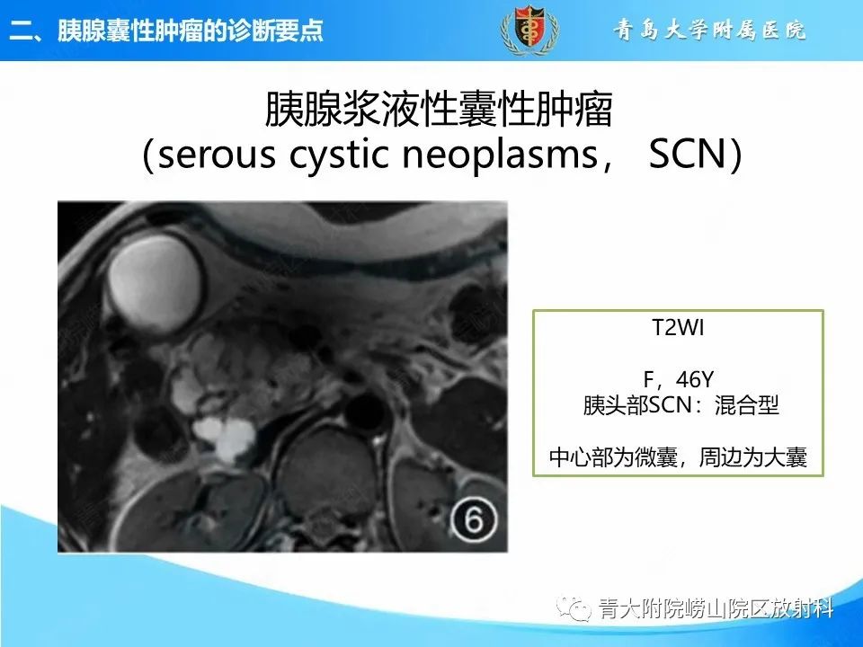 影像PPT - 【PPT】胰腺囊性肿瘤的影像诊断思路-13