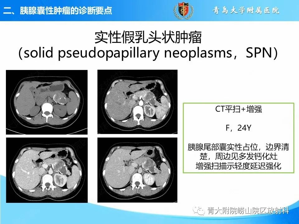 影像PPT - 【PPT】胰腺囊性肿瘤的影像诊断思路-30