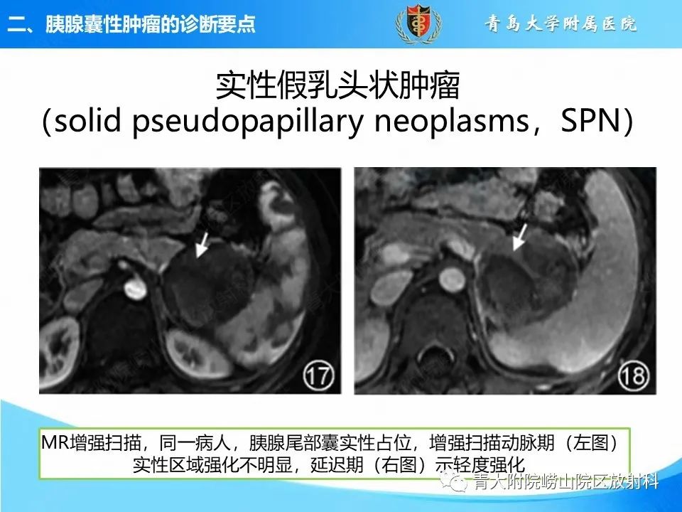 影像PPT - 【PPT】胰腺囊性肿瘤的影像诊断思路-32