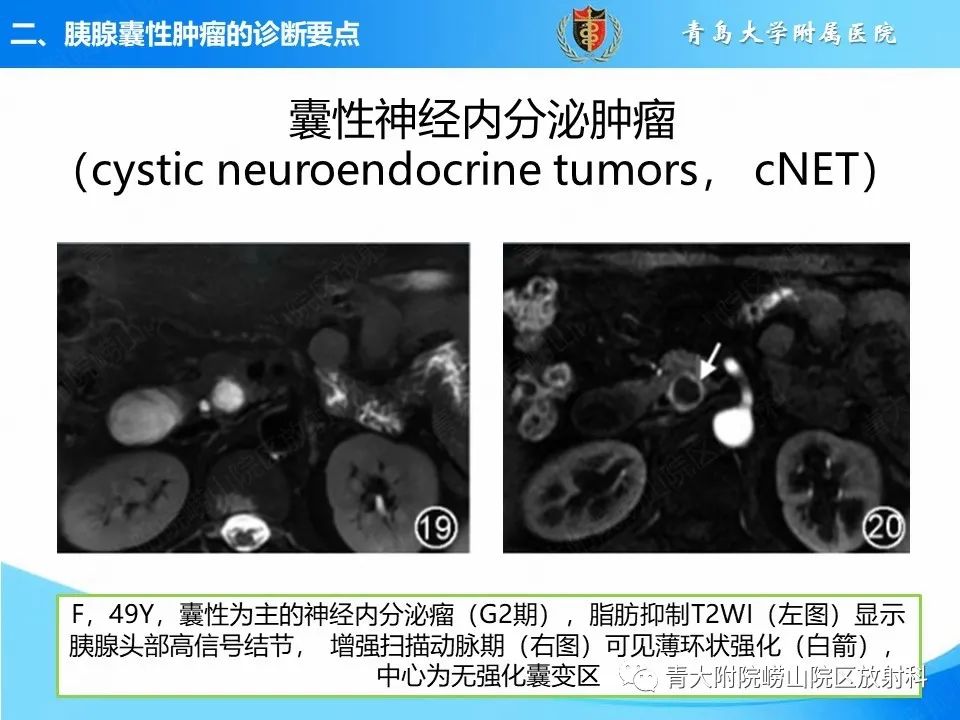 影像PPT - 【PPT】胰腺囊性肿瘤的影像诊断思路-37