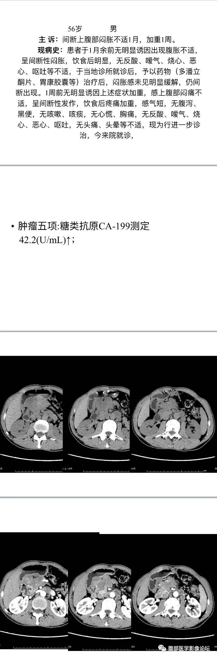 影像PPT - 【病例】胰头癌1例CT及MR-1