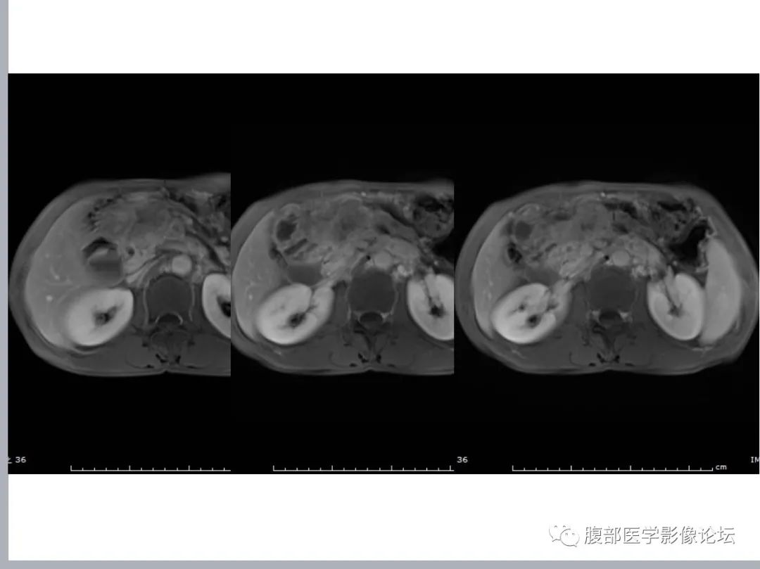 影像PPT - 【病例】胰头癌1例CT及MR-4