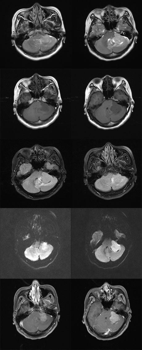 影像PPT - 成人髓母细胞瘤的 MRI 表现-1 影像PPT - 成人髓母细胞瘤的 MRI 表现-1