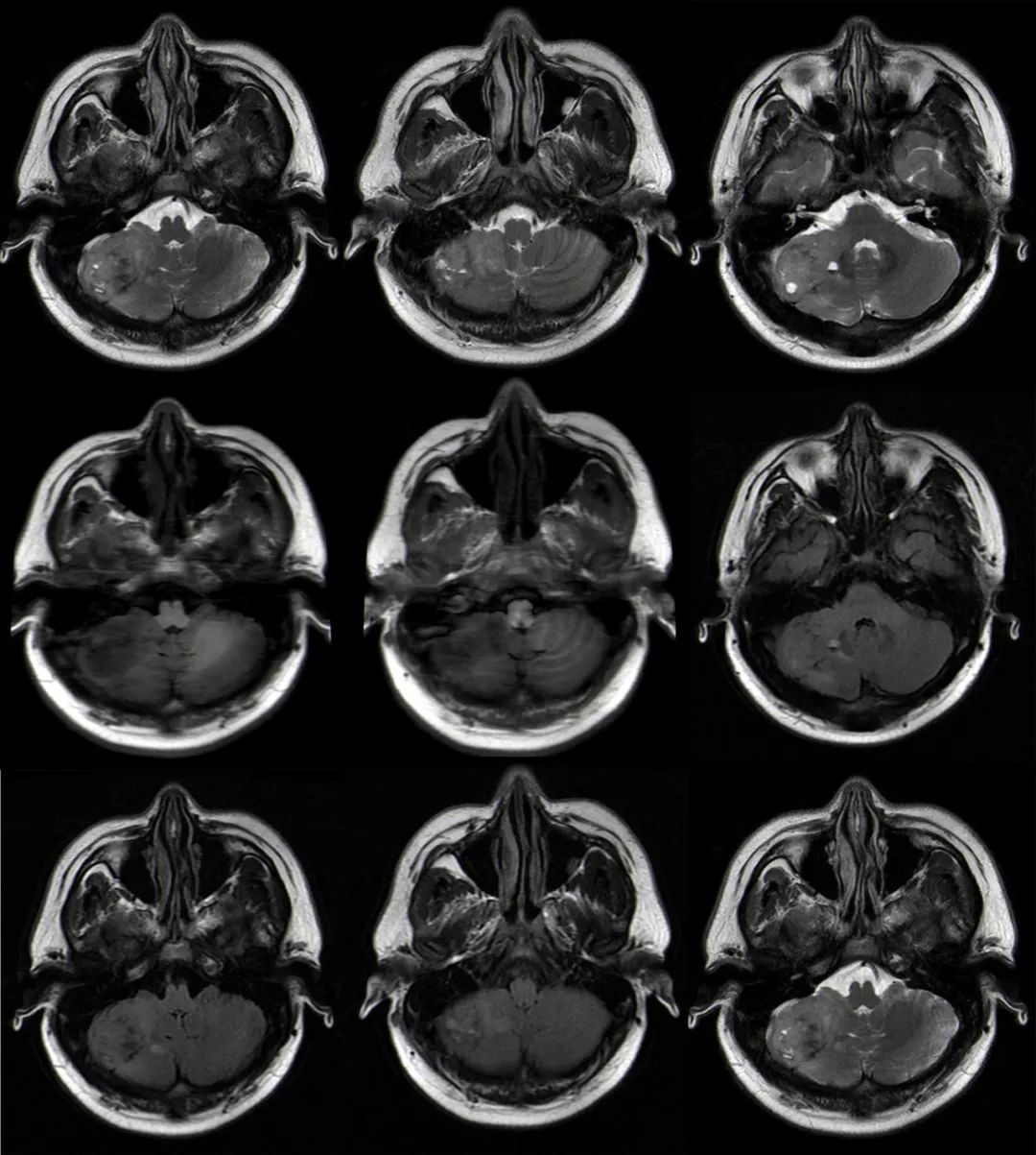 影像PPT - 成人髓母细胞瘤的 MRI 表现-2 影像PPT - 成人髓母细胞瘤的 MRI 表现-2