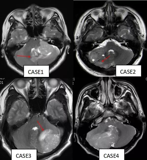 影像PPT - 成人髓母细胞瘤的 MRI 表现-9 影像PPT - 成人髓母细胞瘤的 MRI 表现-9