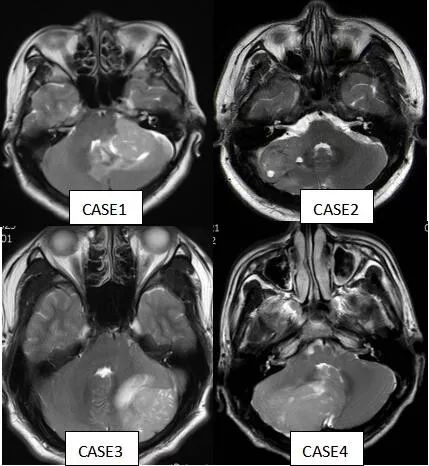 影像PPT - 成人髓母细胞瘤的 MRI 表现-8 影像PPT - 成人髓母细胞瘤的 MRI 表现-8