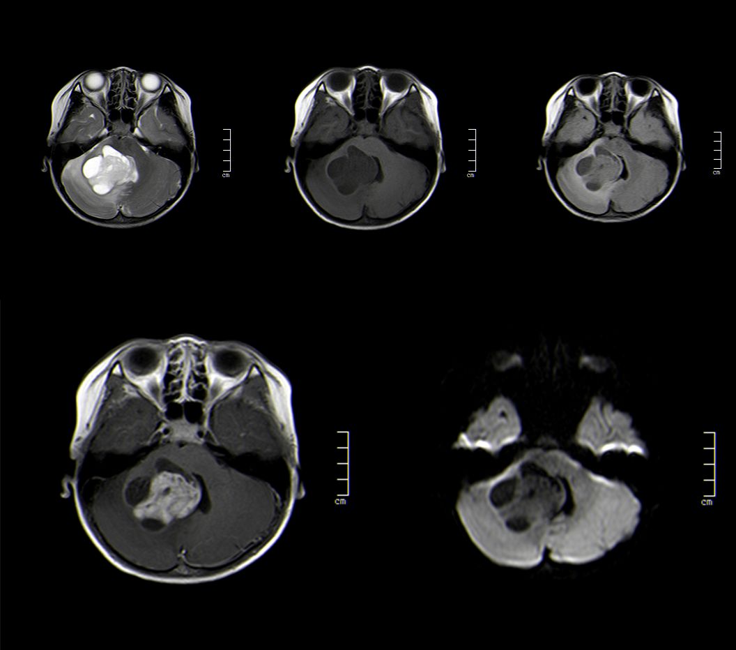 影像PPT - 成人髓母细胞瘤的 MRI 表现-15 影像PPT - 成人髓母细胞瘤的 MRI 表现-15