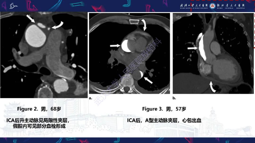 影像PPT - 【PPT】冠状动脉介入及外科手术后并发症影像评估-5