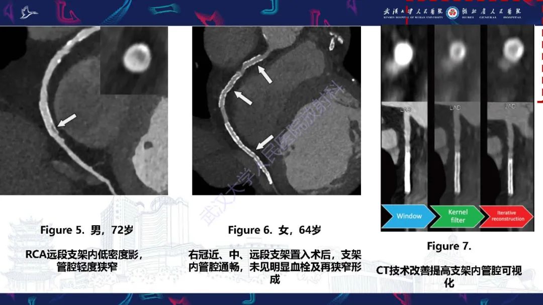 影像PPT - 【PPT】冠状动脉介入及外科手术后并发症影像评估-9