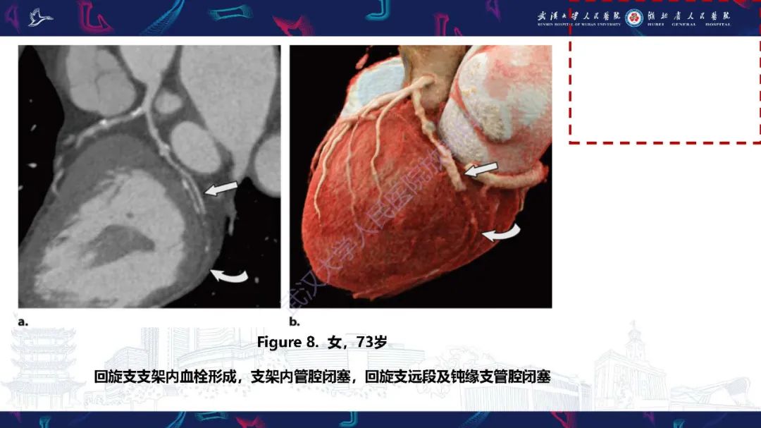 影像PPT - 【PPT】冠状动脉介入及外科手术后并发症影像评估-11