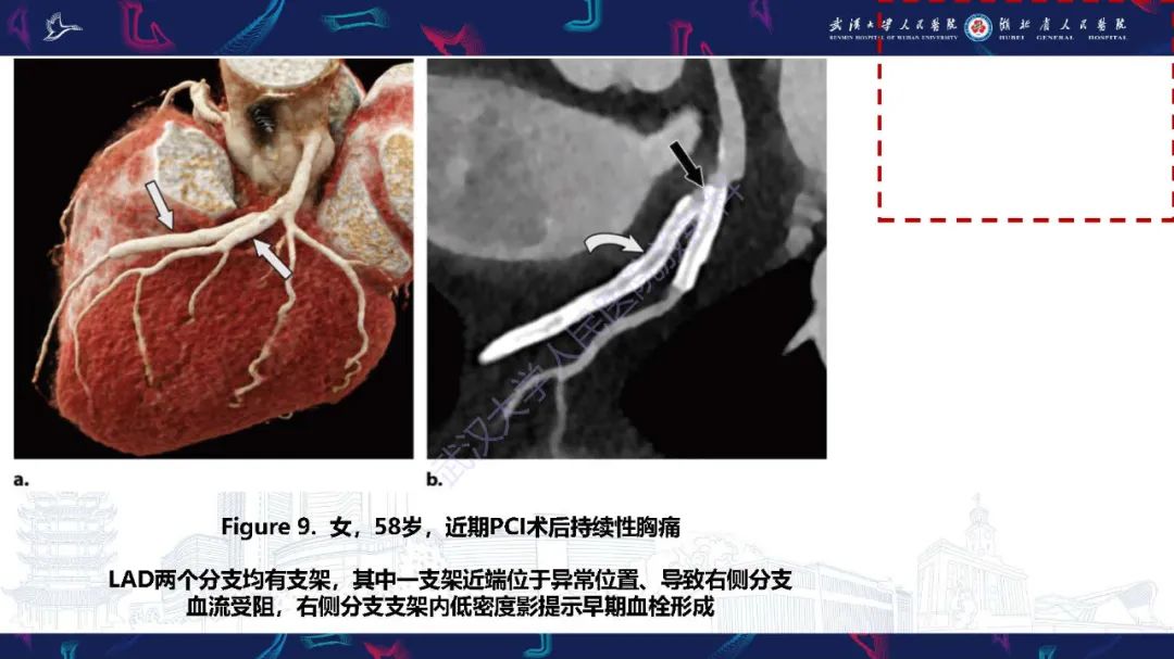 影像PPT - 【PPT】冠状动脉介入及外科手术后并发症影像评估-13