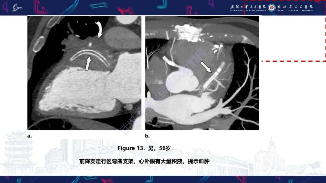 影像PPT - 【PPT】冠状动脉介入及外科手术后并发症影像评估-17