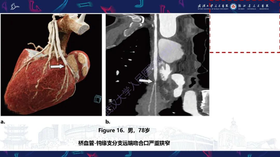 影像PPT - 【PPT】冠状动脉介入及外科手术后并发症影像评估-22