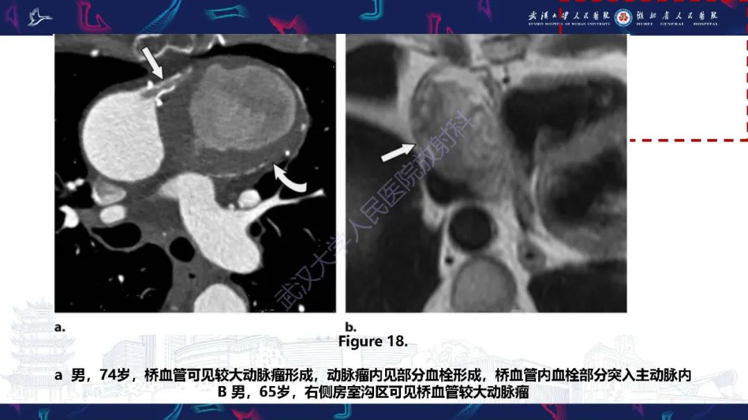 影像PPT - 【PPT】冠状动脉介入及外科手术后并发症影像评估-24