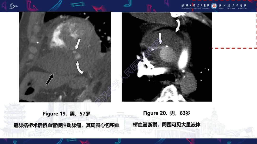 影像PPT - 【PPT】冠状动脉介入及外科手术后并发症影像评估-25