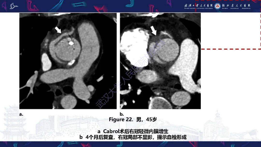 影像PPT - 【PPT】冠状动脉介入及外科手术后并发症影像评估-28