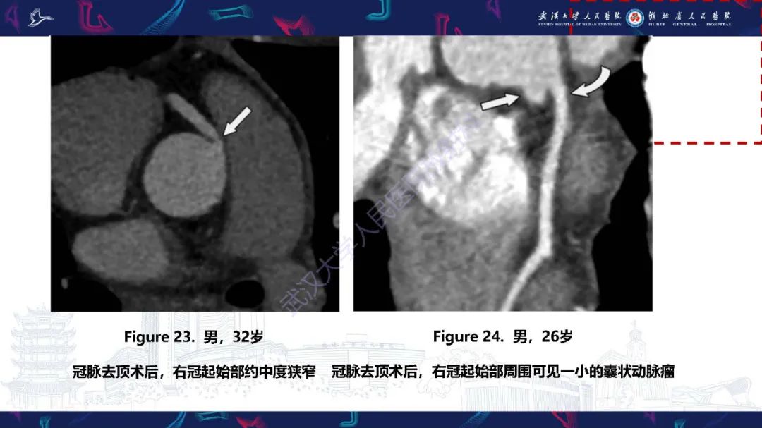 影像PPT - 【PPT】冠状动脉介入及外科手术后并发症影像评估-30