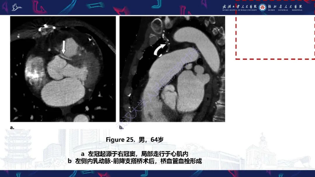 影像PPT - 【PPT】冠状动脉介入及外科手术后并发症影像评估-31