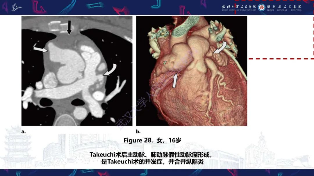 影像PPT - 【PPT】冠状动脉介入及外科手术后并发症影像评估-35