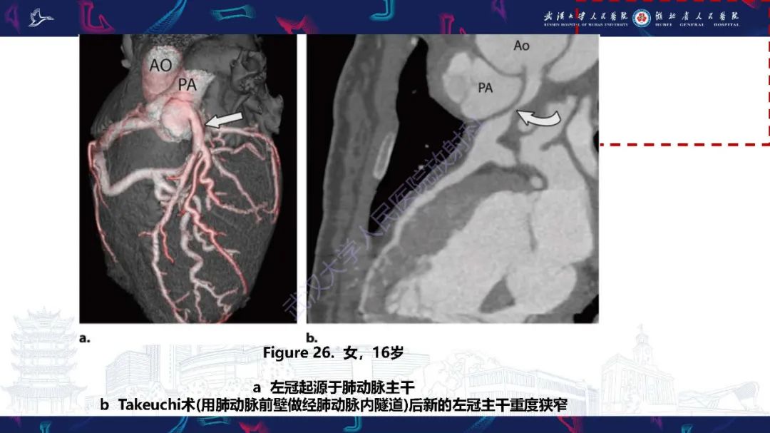 影像PPT - 【PPT】冠状动脉介入及外科手术后并发症影像评估-33