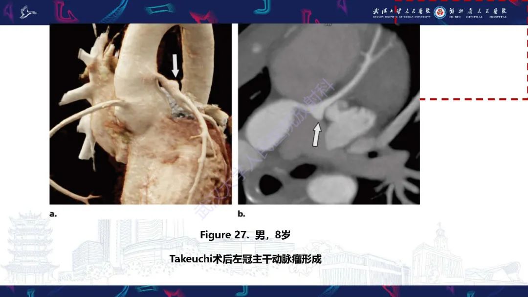 影像PPT - 【PPT】冠状动脉介入及外科手术后并发症影像评估-34
