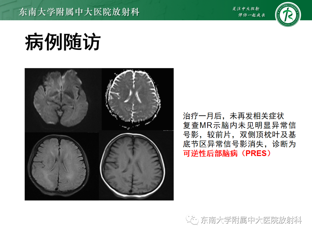 影像PPT - 【PPT】可逆性后部脑病综合征(PRES)1例-4 影像PPT - 【PPT】可逆性后部脑病综合征(PRES)1例-4