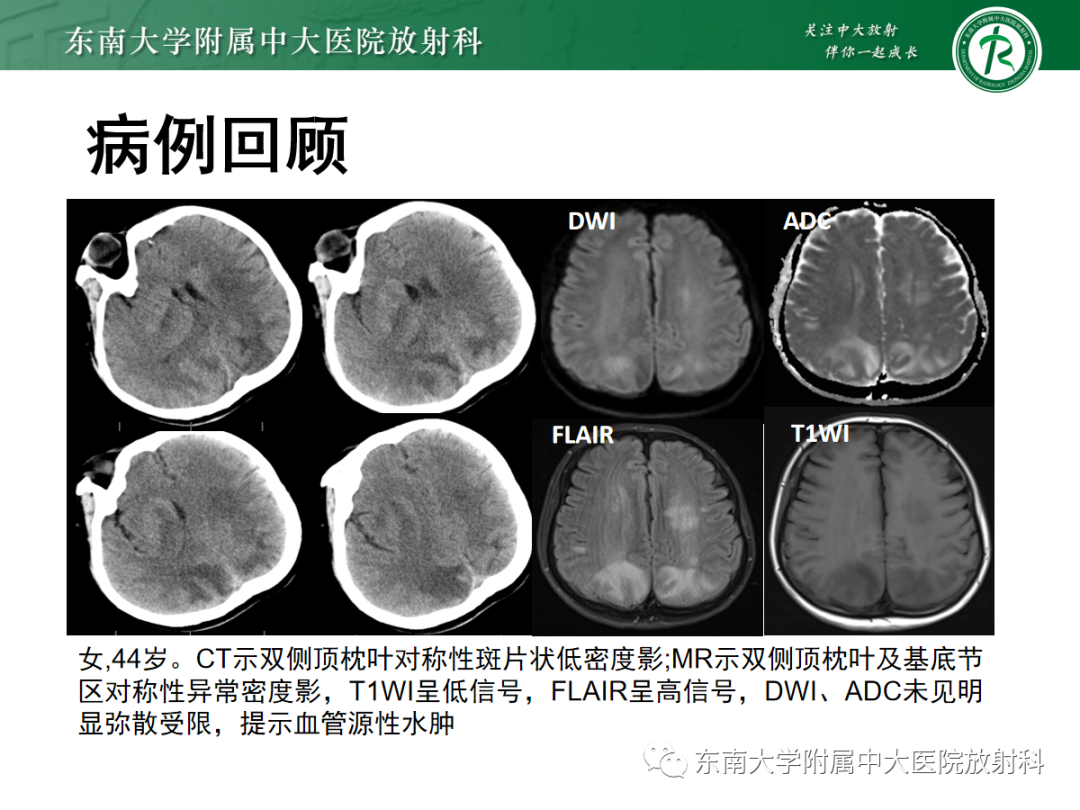 影像PPT - 【PPT】可逆性后部脑病综合征(PRES)1例-3 影像PPT - 【PPT】可逆性后部脑病综合征(PRES)1例-3