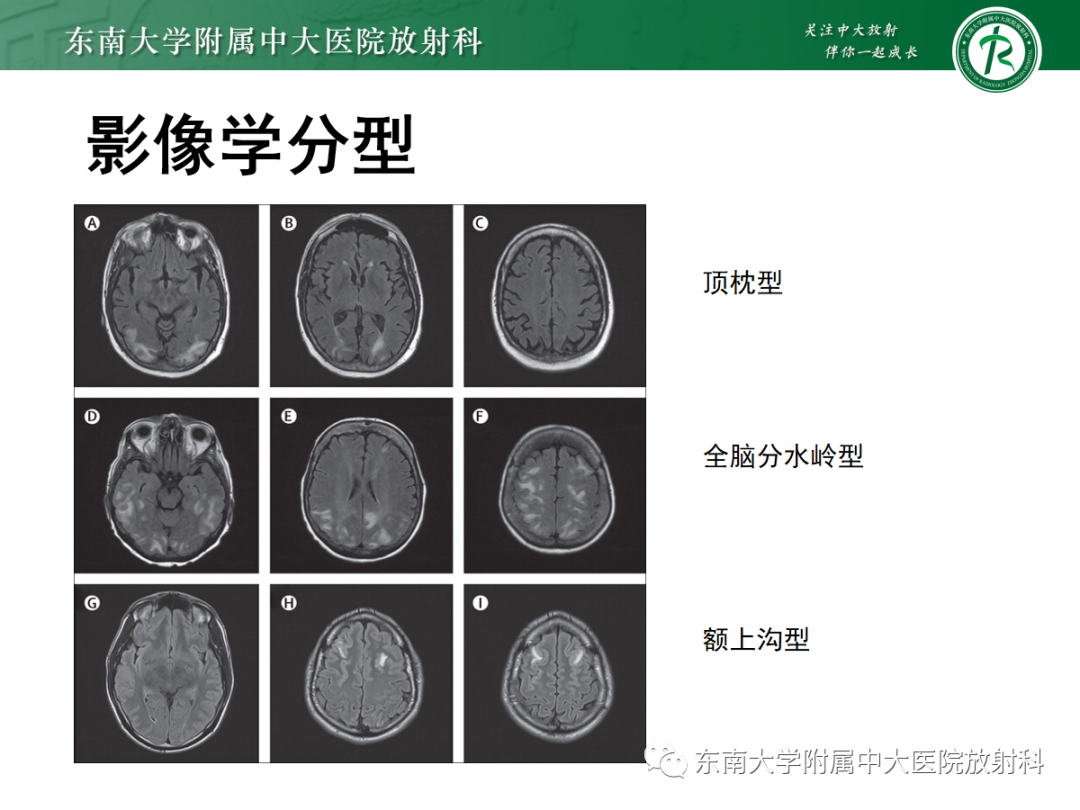 影像PPT - 【PPT】可逆性后部脑病综合征(PRES)1例-14 影像PPT - 【PPT】可逆性后部脑病综合征(PRES)1例-14
