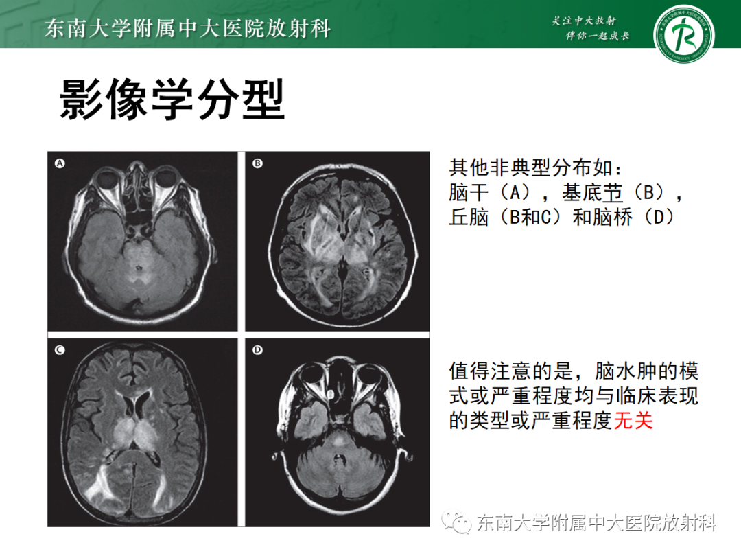 影像PPT - 【PPT】可逆性后部脑病综合征(PRES)1例-15 影像PPT - 【PPT】可逆性后部脑病综合征(PRES)1例-15