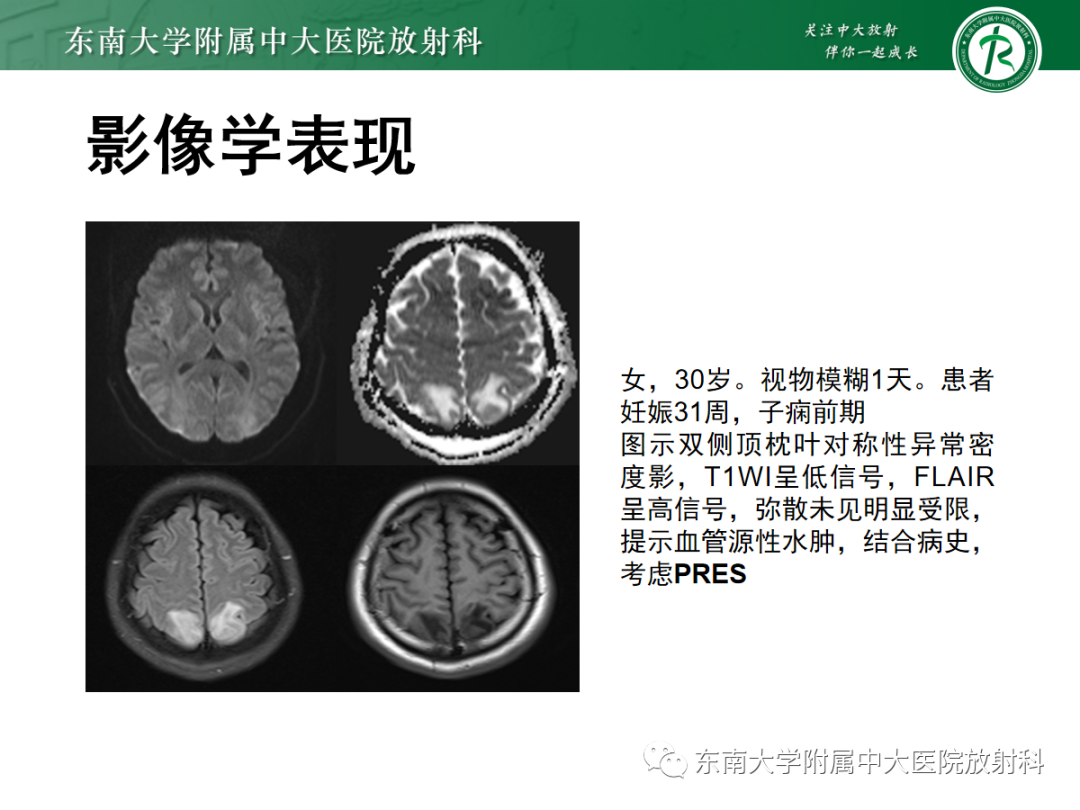 影像PPT - 【PPT】可逆性后部脑病综合征(PRES)1例-17 影像PPT - 【PPT】可逆性后部脑病综合征(PRES)1例-17