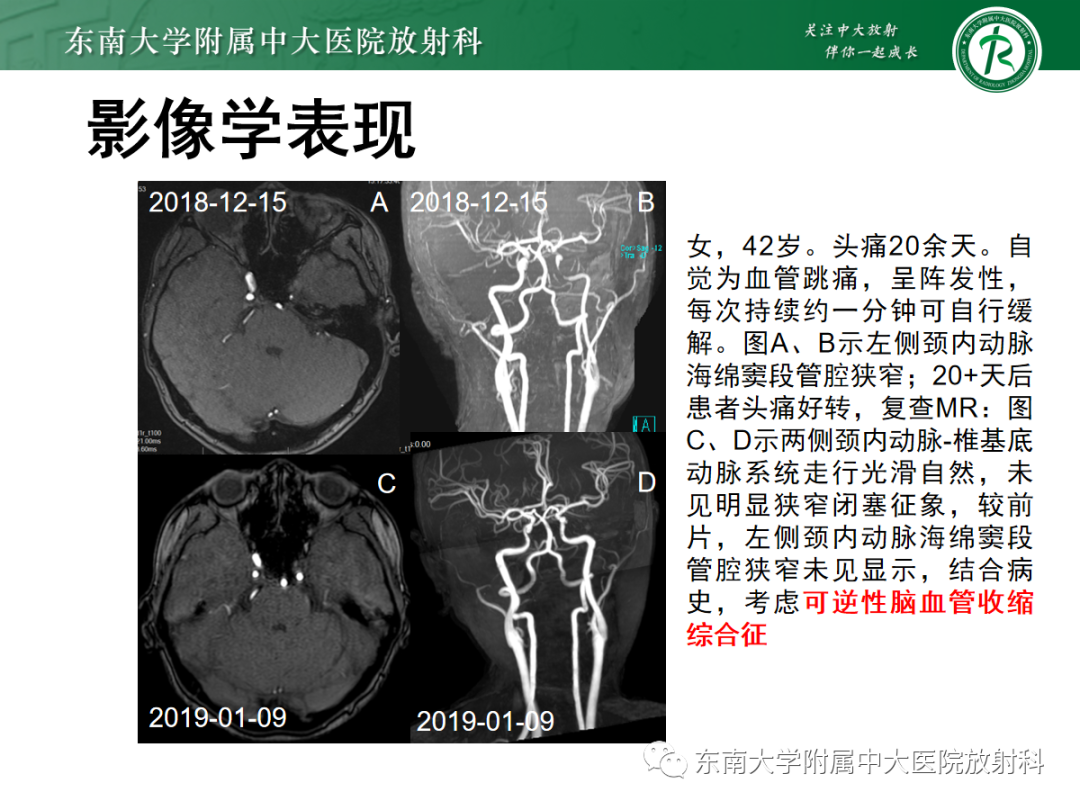 影像PPT - 【PPT】可逆性后部脑病综合征(PRES)1例-21 影像PPT - 【PPT】可逆性后部脑病综合征(PRES)1例-21