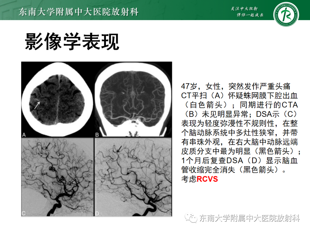 影像PPT - 【PPT】可逆性后部脑病综合征(PRES)1例-22 影像PPT - 【PPT】可逆性后部脑病综合征(PRES)1例-22