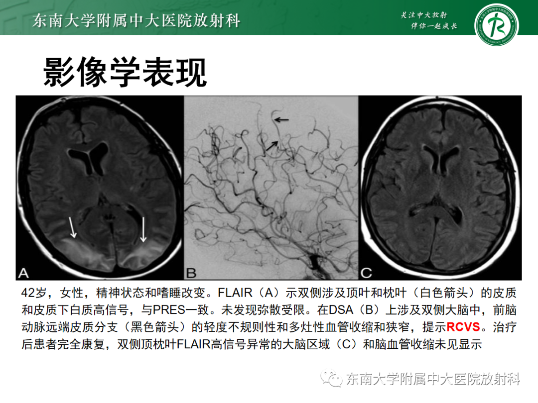 影像PPT - 【PPT】可逆性后部脑病综合征(PRES)1例-24 影像PPT - 【PPT】可逆性后部脑病综合征(PRES)1例-24