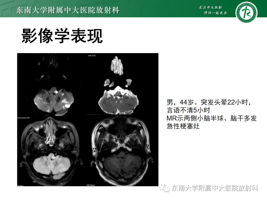 影像PPT - 【PPT】可逆性后部脑病综合征(PRES)1例-26 影像PPT - 【PPT】可逆性后部脑病综合征(PRES)1例-26