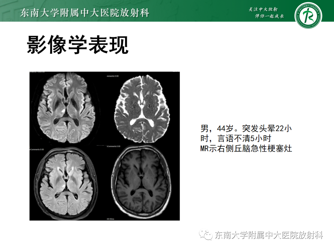 影像PPT - 【PPT】可逆性后部脑病综合征(PRES)1例-27 影像PPT - 【PPT】可逆性后部脑病综合征(PRES)1例-27