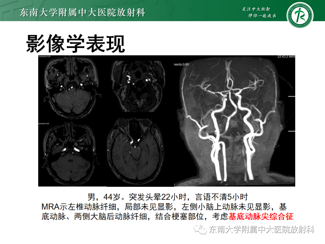 影像PPT - 【PPT】可逆性后部脑病综合征(PRES)1例-28 影像PPT - 【PPT】可逆性后部脑病综合征(PRES)1例-28