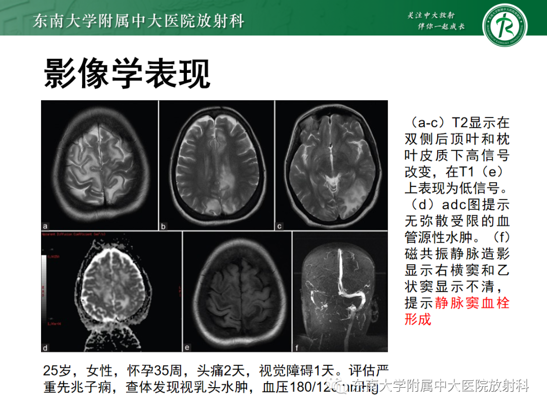 影像PPT - 【PPT】可逆性后部脑病综合征(PRES)1例-30 影像PPT - 【PPT】可逆性后部脑病综合征(PRES)1例-30