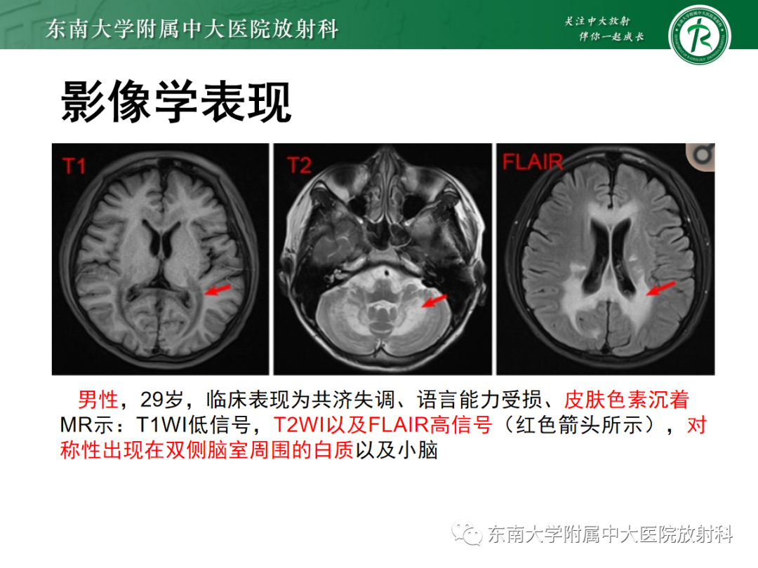 影像PPT - 【PPT】可逆性后部脑病综合征(PRES)1例-32 影像PPT - 【PPT】可逆性后部脑病综合征(PRES)1例-32