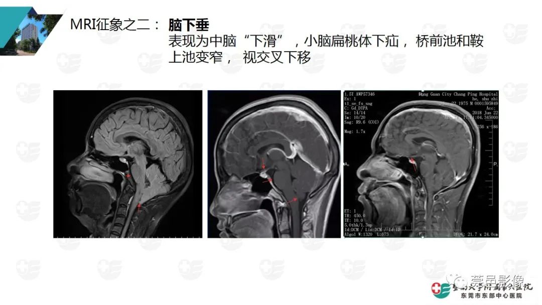 影像PPT - 【PPT】低颅压综合症影像诊断-8