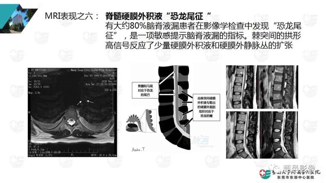 影像PPT - 【PPT】低颅压综合症影像诊断-12